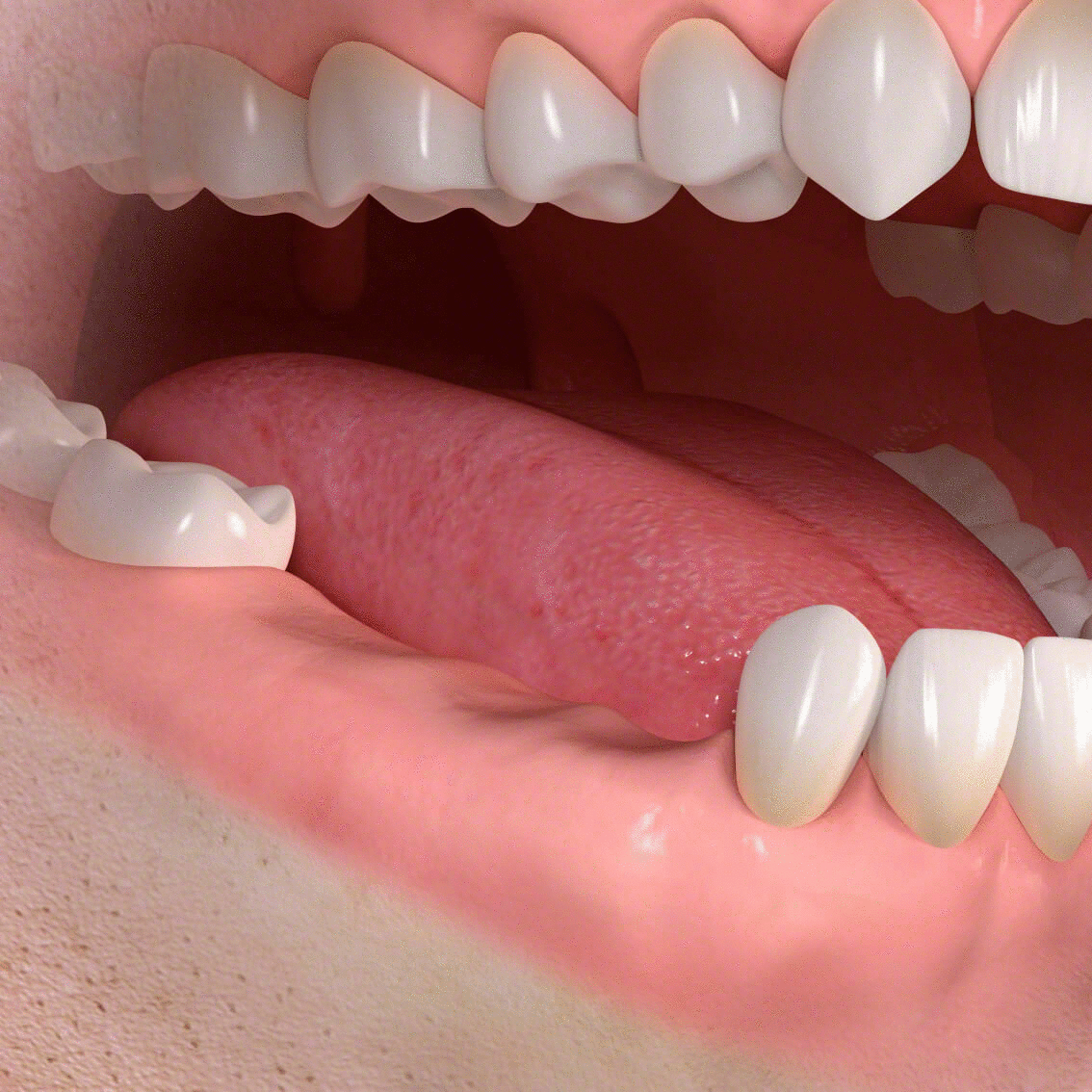 複数歯