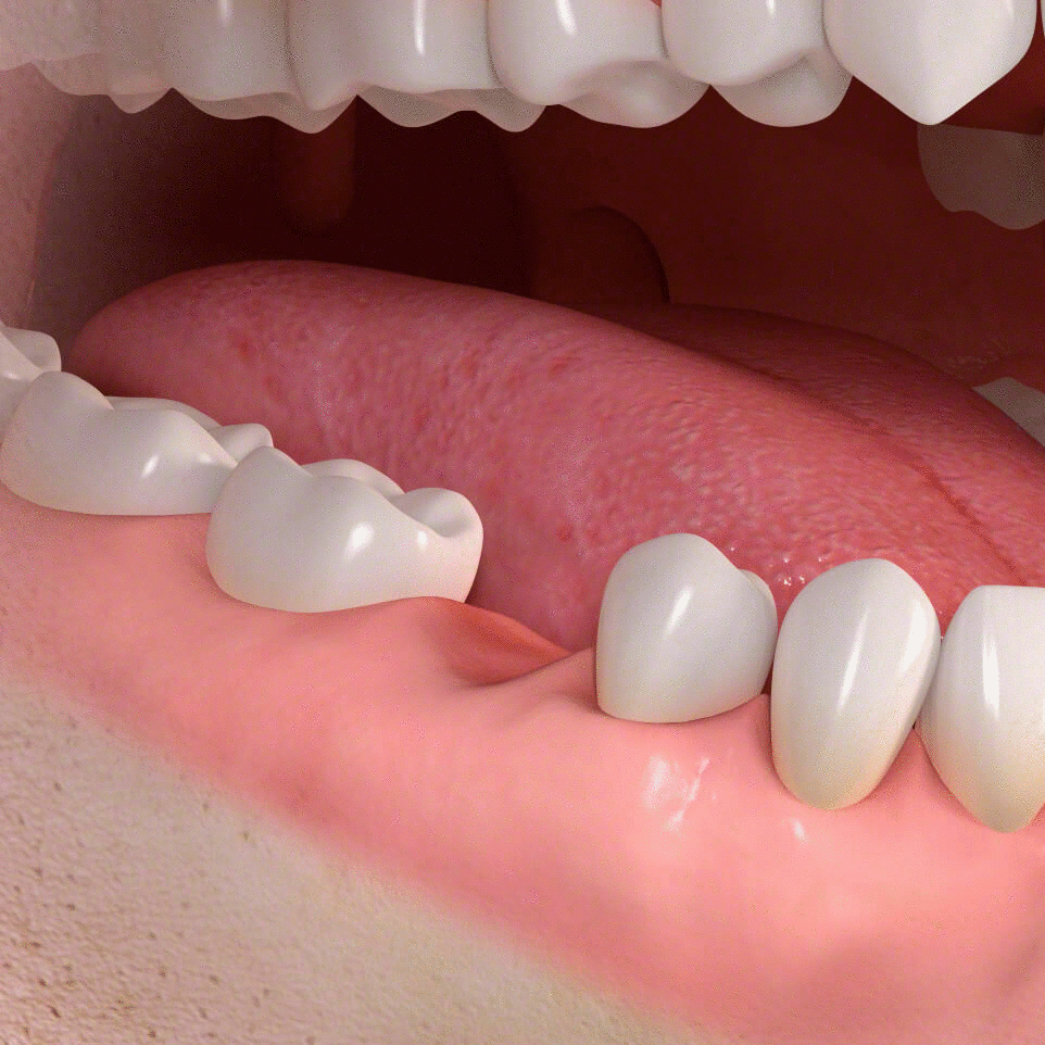 単独歯